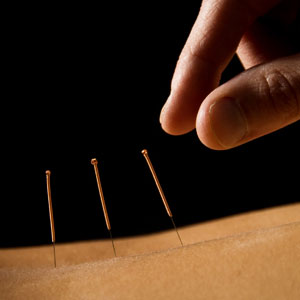 Acupuncture