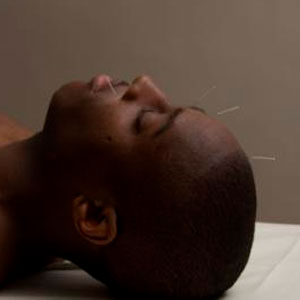 Cosmetic Acupuncture